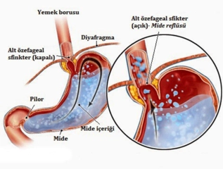 Özofajial Reflü Belirtileri ve Tedavisi
