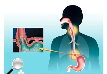 Reflü Ameliyatı Reflü Ameliyat Türleri
